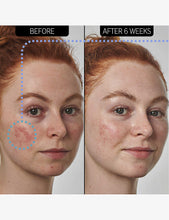 Super Solutions 10% Azelaic Acid Serum 30ml
